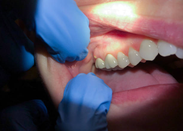 Best Emergency Dental Extractions in West Falmouth, MA